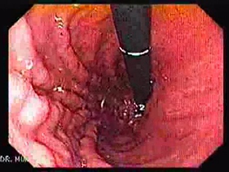 Esophageal Varices - Endoscopy (4 of 5)