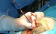 Neuronavegador