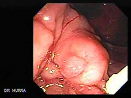 Adenocarcinoma of the Pancreas (1 of 8)