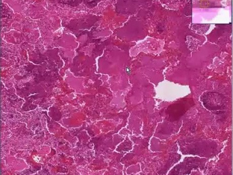 Aspiration pneumonia, infant