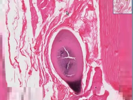 Trichinosis