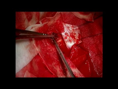 Falx meningioma