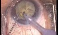 Cataract Surgery - Phacoemulsification