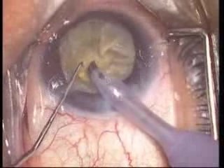Cataract Surgery - Phacoemulsification