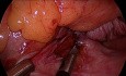 vNOTES Uterosacral Suspension for Procidentia