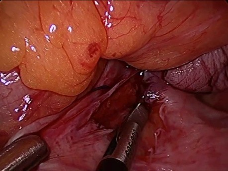 vNOTES Uterosacral Suspension for Procidentia