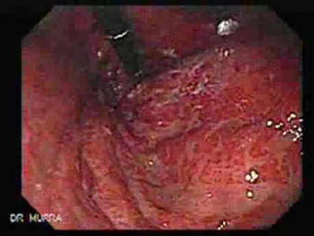 Gastroesophagic Varices - 66 - Year - Old Man (2 of 7) 
