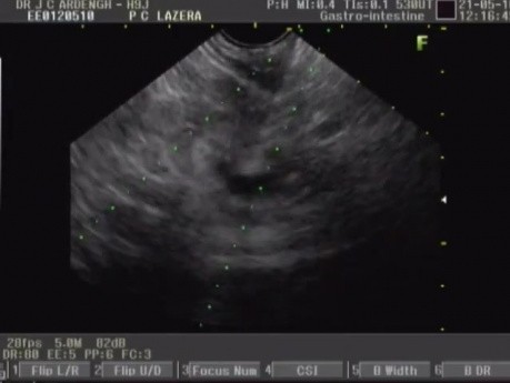 Cystic tumor in pancreas
