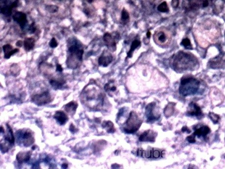Endoscopy of Scirrhous Gastric Carcinoma involving the entire Fundus, Body and the Antrum (6 of 47)