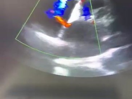  A Residual ASD After Septostomy 