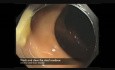 Colonoscopy Channel - Subtle Lesion Hidden Under Fluid And Debris