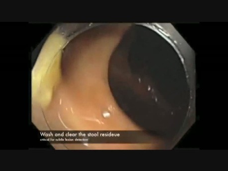 Colonoscopy Channel - Subtle Lesion Hidden Under Fluid And Debris
