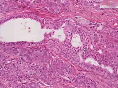 Epithelial hyperplasia