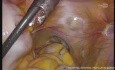Total laparoscopic proctectomy plus coloanal anastomosis without protective ileostomy