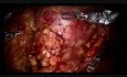 Robot-Assisted Partial Nephrectomy with Supra Selective Clamping by Alex Mottrie