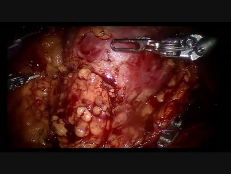 Robot-Assisted Partial Nephrectomy with Supra Selective Clamping by Alex Mottrie