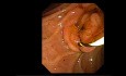 Cystic Duct Stone Removal After Cholecystectomy