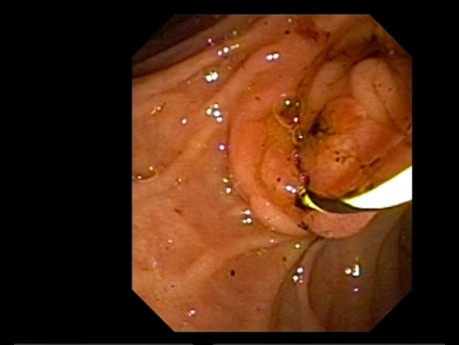 Cystic Duct Stone Removal After Cholecystectomy