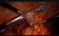 Transvaginal-Assisted Mini Laparoscopic Right Hemicolectomy