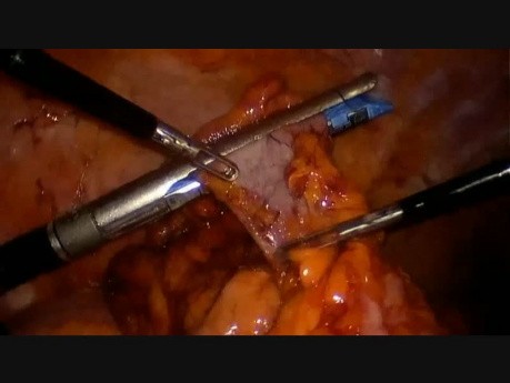 Transvaginal-Assisted Mini Laparoscopic Right Hemicolectomy