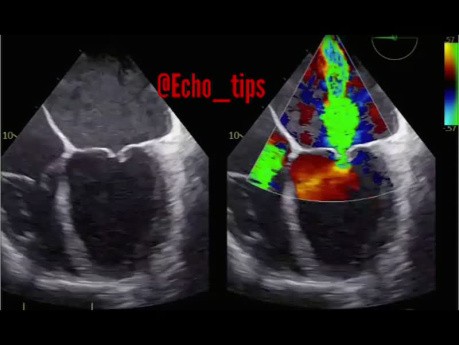 TEE Visualization of Severe Mitral Valve Incompetence: Mal-Coapted Leaflets and Central Jet