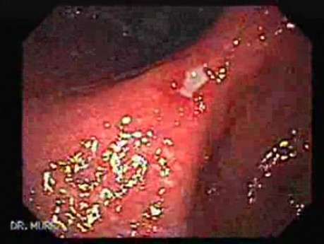 Gastric Ulcer - Endoscopy (3 of 3)