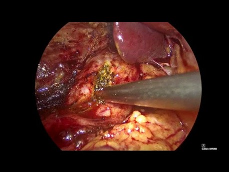 Laparoscopic Choledochotomy and Drainage of Liver Abcess