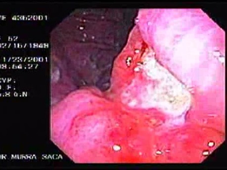 Ulcerated Gastric Adenocarcinoma (2 of 2)
