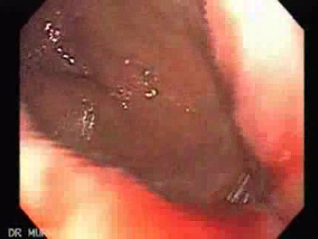 Bleeding Due to Dieulafoy´s Lesion (1 of 7)
