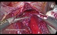 Technique of Heller Myotomy for Achalasia