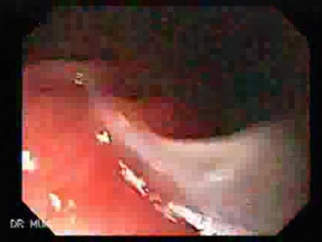 Hourglass Stomach - Endoscopic Maneuvers
