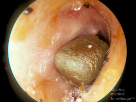 Foreign Body [stone] Ear Canal