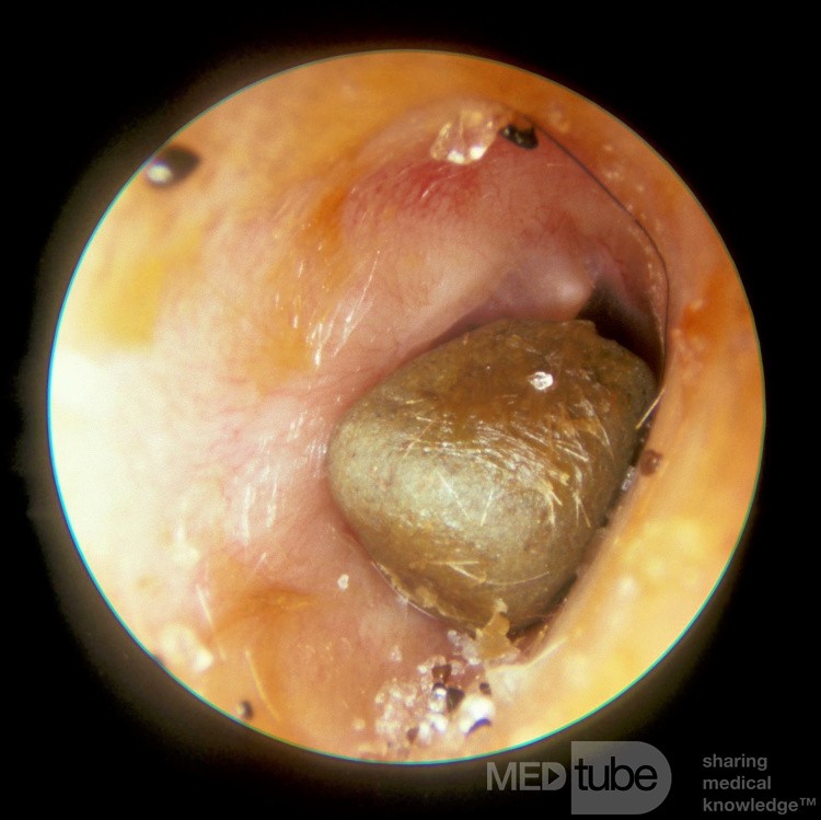 Foreign Body [stone] Ear Canal
