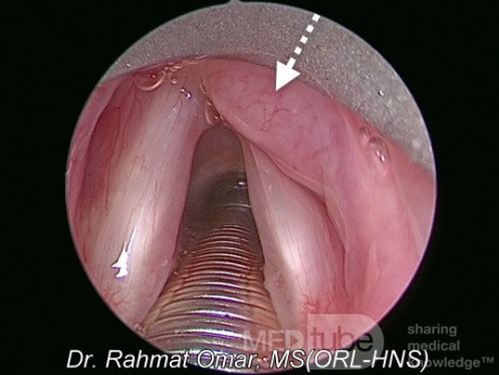 Laryngeal Lymphoma