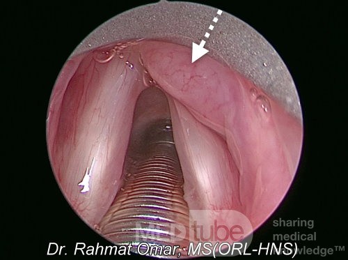 Laryngeal Lymphoma