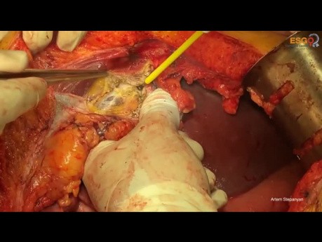 Right Upper Quadrant Peritonectomy - Answering Ten Frequently Asked Questions