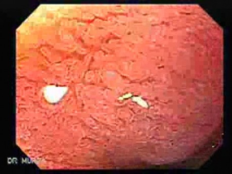 Duodenum - Magnifying Endoscopy