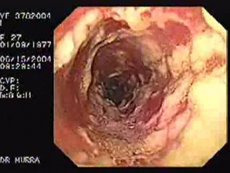 Oropharynge-Esophagic Candidiasis HIV-positive female patient (1 of 5)