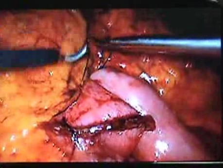 Jejunal Gastrointestinal Stromal tumor (GIST) (37 of 86)