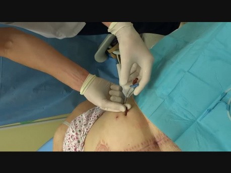 Management of Symptomatic, Post-operative Lymphocysts with an Easy-to-use, Patient-Controlled Vascular Catheter
