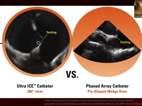 An Introduction to Intracardiac Echocardiography (ICE)