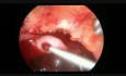 Laparoscopic Salpingectomy Due to EP With Hemoperitonium