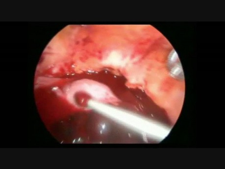 Laparoscopic Salpingectomy Due to EP With Hemoperitonium