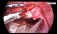 Laparoscopic Ovarian Cystectomy for Endometrioma