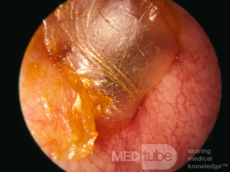 Thin Veil of Cerumen Occluding the External Canal