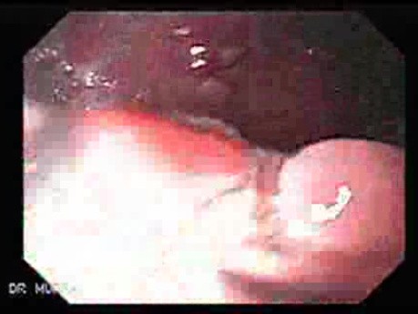 Gastric Polyposis - Endoscopy (1 of 11)