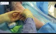 Venous Access Made Easy Video (6)