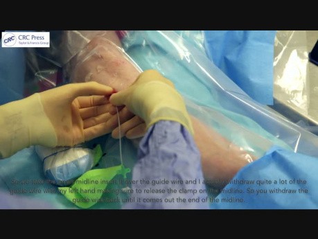 Venous Access Made Easy Video (6)