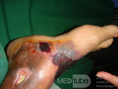 Diabetic foot - hemorrhagic bollus - tight bandage 3