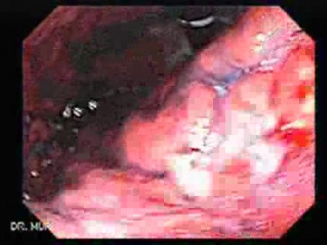 Adenocarcinoma of the Lesser Curvature with Signet Ring Cells (7 of 8)